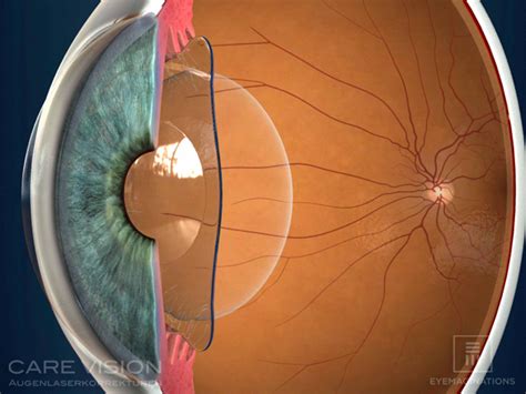 Lentes intraoculares fáquicas